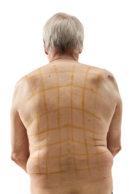 iodine net on patient back