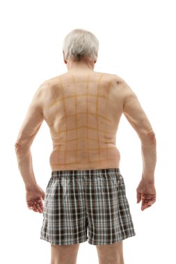 iodine net on patient back