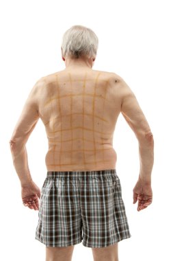 iodine net on patient back