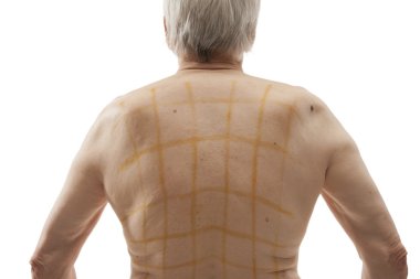 iodine net on patient back