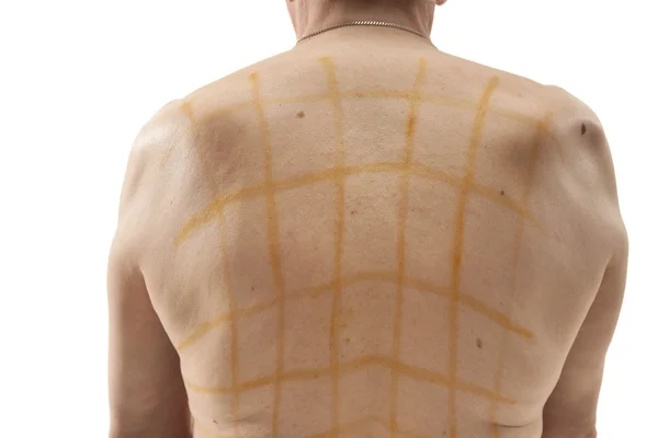 Iodine net on patient back — Stockfoto