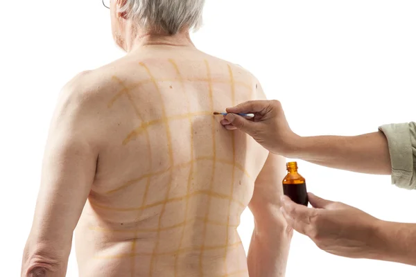 Male doctor applying iodine net — Stockfoto