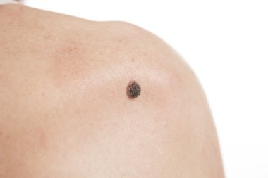 Skuamöz Hücre Karsinomu derinin keratinizing