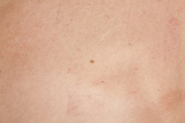 Skuamöz Hücre Karsinomu derinin keratinizing