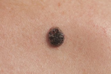 Skuamöz Hücre Karsinomu derinin keratinizing