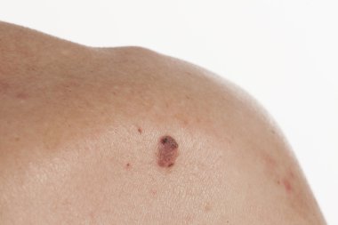 Skuamöz Hücre Karsinomu derinin keratinizing