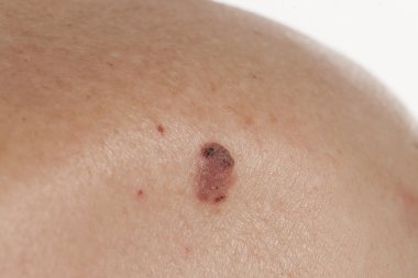 Skuamöz Hücre Karsinomu derinin keratinizing