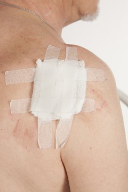 Skuamöz Hücre Karsinomu derinin keratinizing