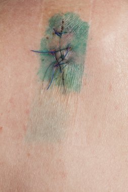 Skuamöz Hücre Karsinomu derinin keratinizing