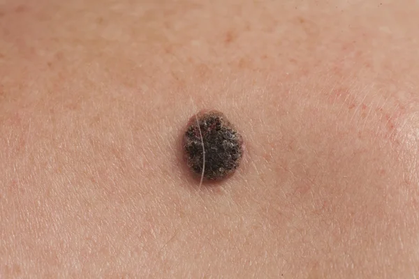 Skuamöz Hücre Karsinomu derinin keratinizing