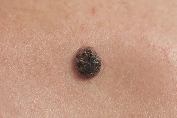 Skuamöz Hücre Karsinomu derinin keratinizing