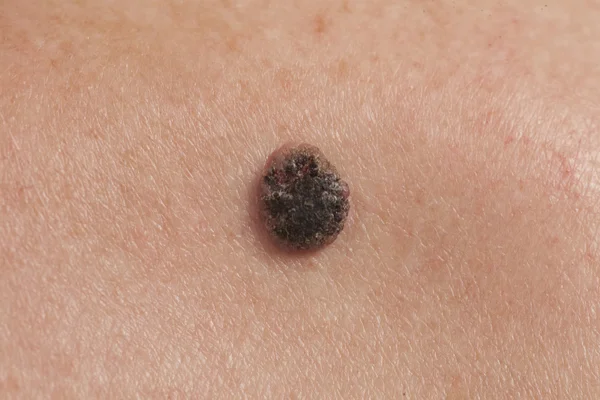 Skuamöz Hücre Karsinomu derinin keratinizing