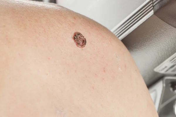 Skuamöz Hücre Karsinomu derinin keratinizing
