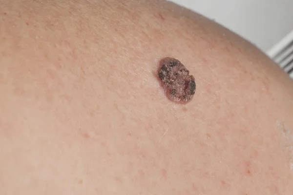 Carcinoma espinocelular queratinizante da pele — Fotografia de Stock