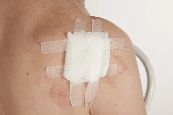 Skuamöz Hücre Karsinomu derinin keratinizing