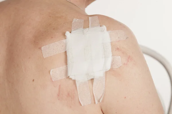 Skuamöz Hücre Karsinomu derinin keratinizing