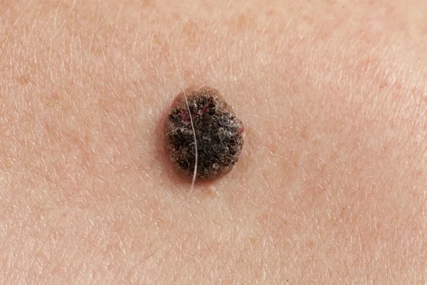 Carcinoma de células escamosas queratinizante de la piel Imagen De Stock