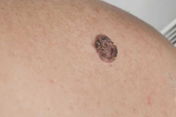 Keratinizing plaveiselcelcarcinoom van de huid Stockfoto