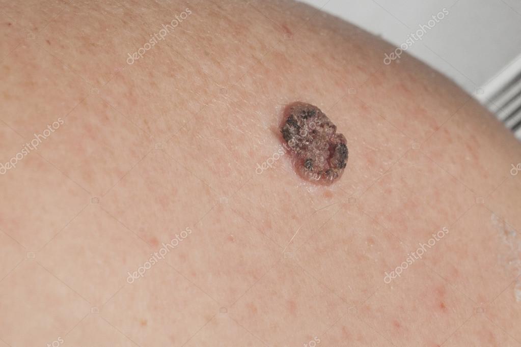 皮肤高分化鳞癌图片