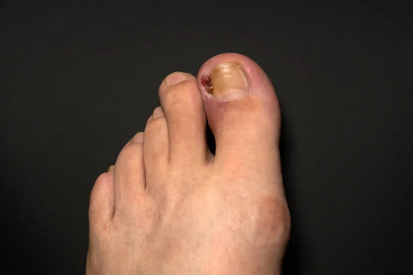 Ingrown Nail Purulent Onychocryptosis Leg Close Wound Black Background — Stock Photo, Image