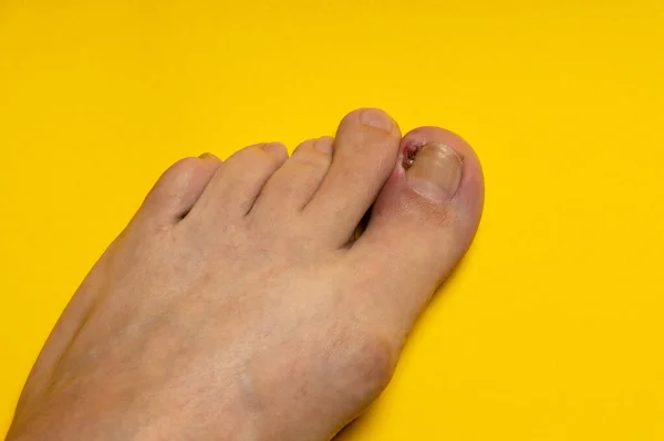 Ingrown Nail Purulent Onychocryptosis Leg Close Wound Yellow Isolated — Stock Photo, Image