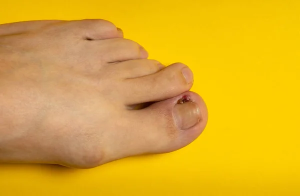 Ingrown nail or purulent onychocryptosis. Leg with wound on a yellow background