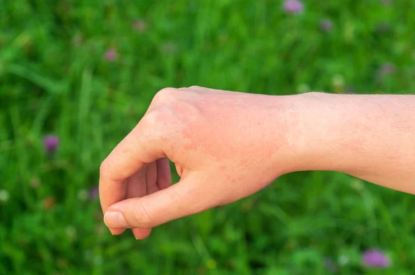 Ponto Quente Vermelho Alergia Sol Braço Geralmente Doloroso Itchy — Fotografia de Stock