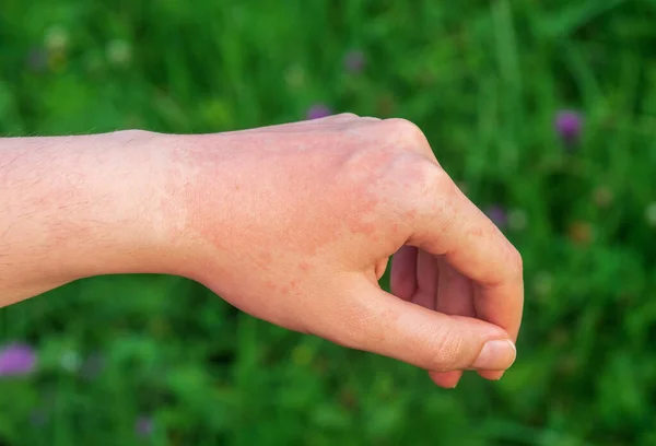 Red Hot Sun Allergy Spot Arm Usually Painful Itchy Allergic — Stock Photo, Image