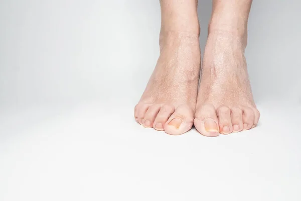 Close-up female sore skin of feet, dry heels isolated on a white background