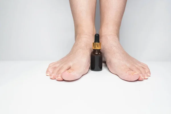 Feet with dry skin before oil treatment. Woman foot with an esential oil bottle