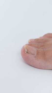 Tırnak mantarından etkilenen bir insan ayak parmağının yakın çekimi, renk değişen tırnağı ve etrafındaki deri dokusunu vurguluyor, ayak sağlığı endişelerini temsil ediyor.