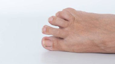 İnsan ayağına yakın çekim, görünür tırnak sedef hastalığı, etkilenmiş ayak tırnakları ve deri dokusunun sergilenmesi, sağlık sorunları ve kişisel bakım