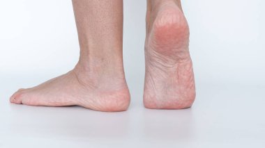Ayakların nasır ve nasır gösterme, cilt dokusunu ve sağlık sorunlarını vurgulama, eğitim ve tıbbi amaçlar için uygun