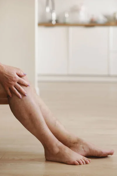 Bolestivé Křečové Pavoučí Žíly Aktivních Ženských Nohou Které Samy Pomáhají — Stock fotografie