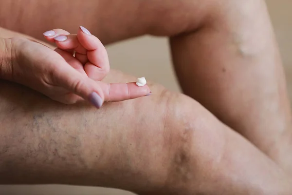 Mujer Frota Las Piernas Cansadas Con Una Crema Especial Para — Foto de Stock