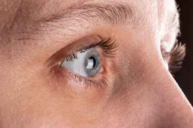 Kornea distrofisi olan kadın gözü, keratoconus, kornea incelmesi.