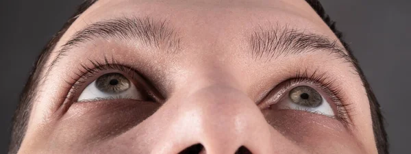 Man with stage 3 keratoconus in the eyes,corneal dystrophy — Fotografia de Stock