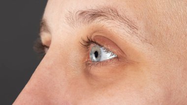 Kadın gözüne keratoconus, kornea distrofisi teşhisi konuldu.
