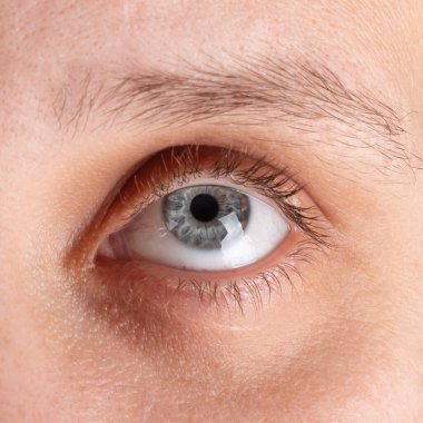 Gözüne keratoconus teşhisi konuldu