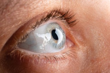 beautiful female eye, diagnosis of keratoconus corneal dystrophy clipart