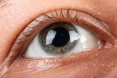 Keratoconus 'un gözü yakın plan, kornea incelmesi..