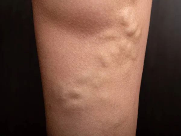 Leg Varicose Veins Closeup — Foto de Stock