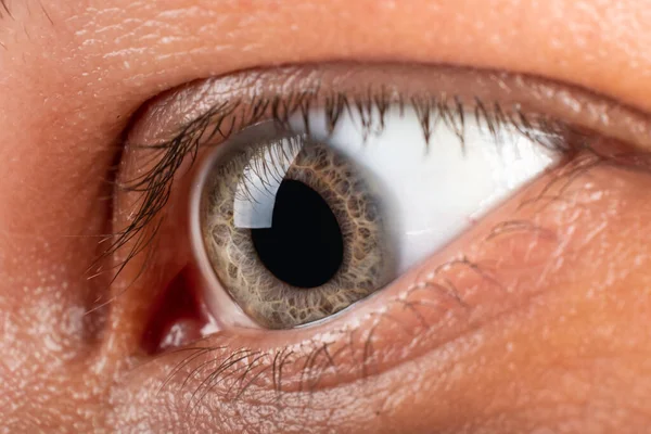 Patient Keratokonus Eye Closeup Corneal Dystrophy Diagnosis — ストック写真