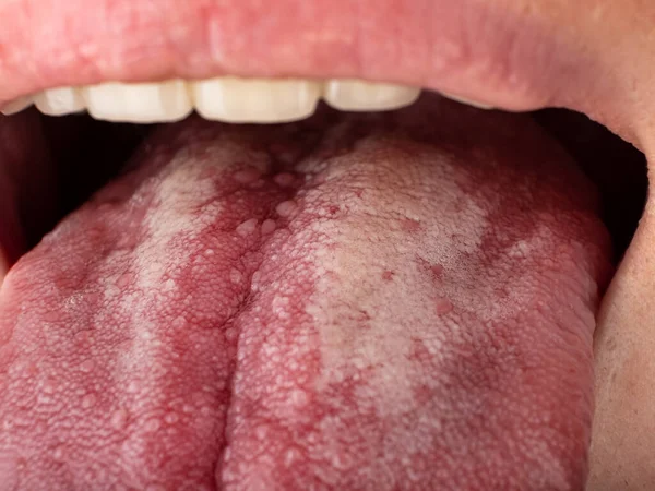 Γλώσσα με στοματίτιδα από κοντά, καρκίνος του στόματος — Φωτογραφία Αρχείου