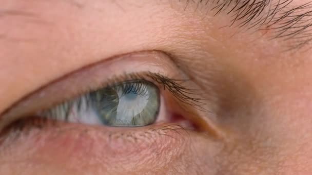 Vrouwelijk oog met keratoconus, dunner worden van het hoornvlies — Stockvideo