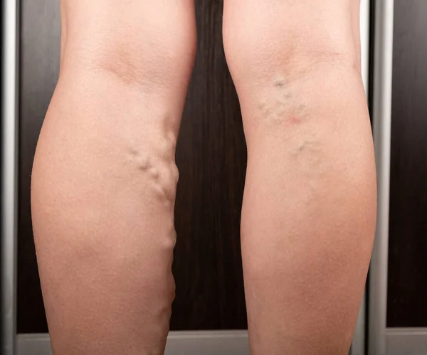 Женщина с варикозным расширением ног, тромбозом вздутых вен — стоковое фото