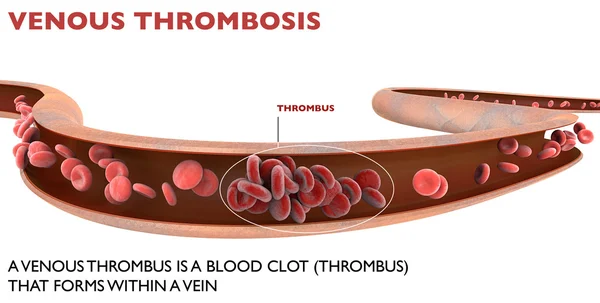 Vörös vérsejtek, eritrocita sejtek, áramlás-vörösvértestek — Stock Fotó