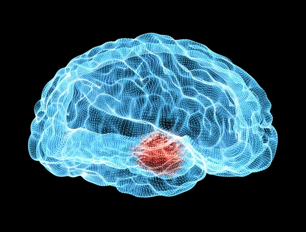 Дегенеративные заболевания мозга, Паркинсон — стоковое фото