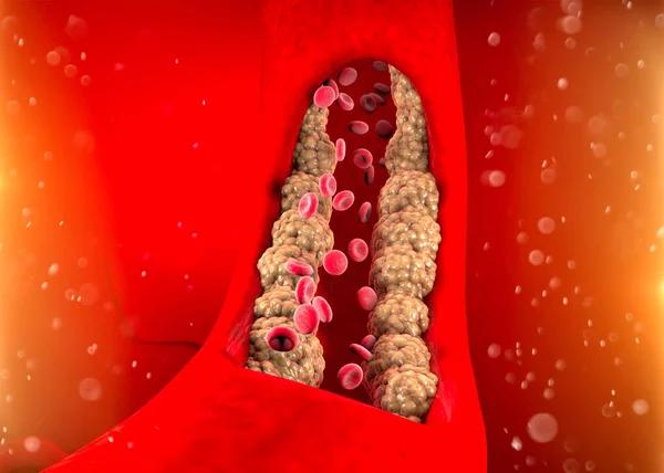Formacja Cholesterolu Tłuszcz Tętnica Żyły Serce Czerwone Krwinki Przepływ Krwi — Zdjęcie stockowe