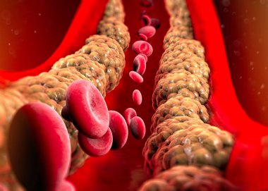 Cholesterol formation, fat, artery, vein, heart. Red blood cells, blood flow. Narrowing of a vein for fat formation. Surgery operation, 3d render clipart